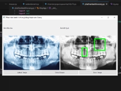 (Xử lí ảnh) Chương trình phát hiện bệnh lí về răng sử dụng thuật toán Canny và Gaussian Blur Python